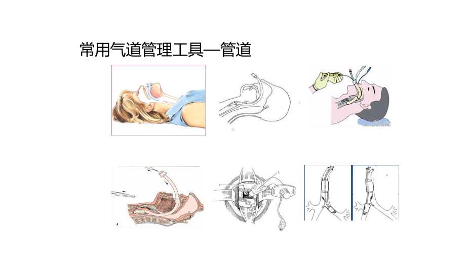 医学可视喉镜新技术PPT培训课件.ppt_第3页