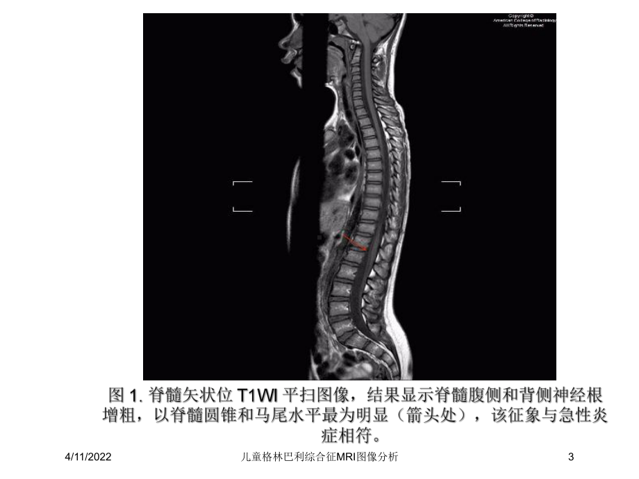 儿童格林巴利综合征MRI图像分析课件.ppt_第3页