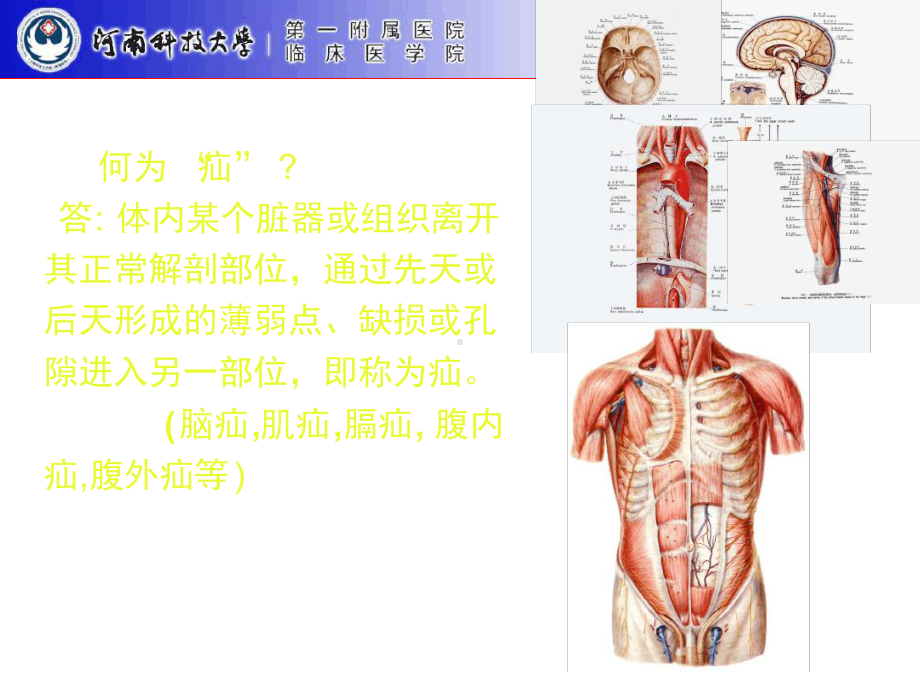 小儿腹股沟斜疝微创治疗课件.ppt_第3页