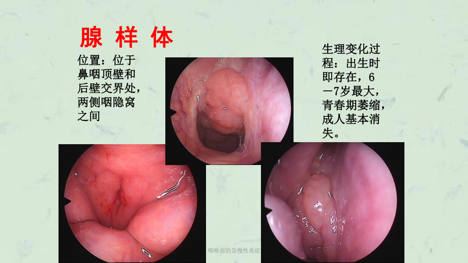 咽喉部的急慢性炎症课件.ppt_第3页