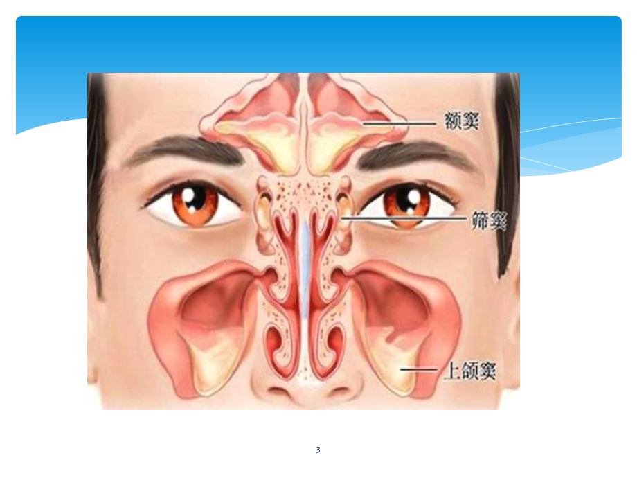 鼻窦炎PPT课件.ppt_第3页