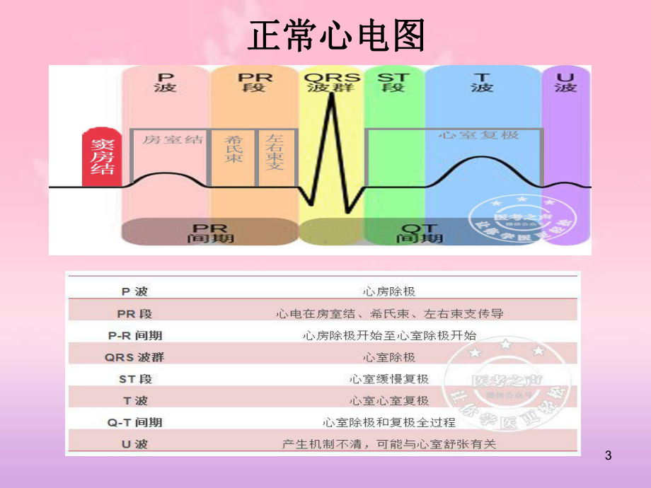 儿童阵发性室上性心动过速ppt课件.ppt_第3页