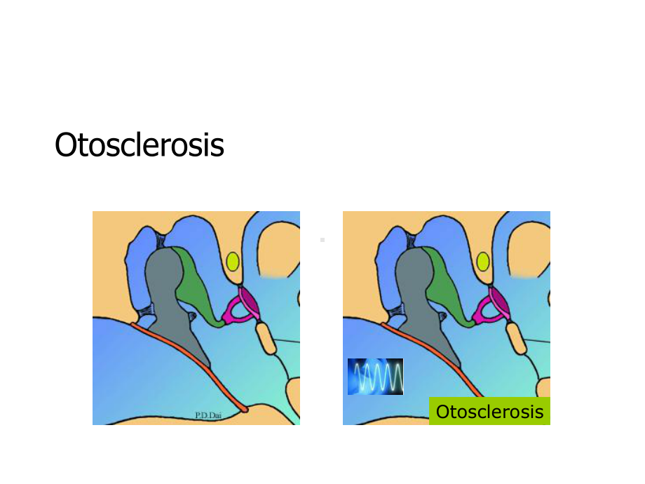 耳鼻咽喉科学英文版课件 otosclerosis.ppt_第1页