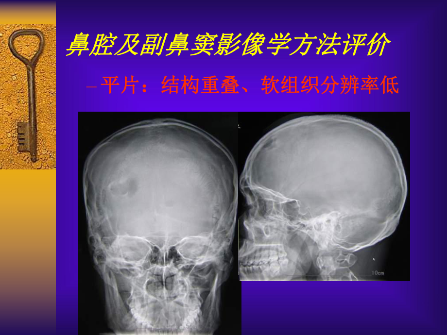 鼻腔及副鼻窦病变影像诊断课件.ppt_第3页