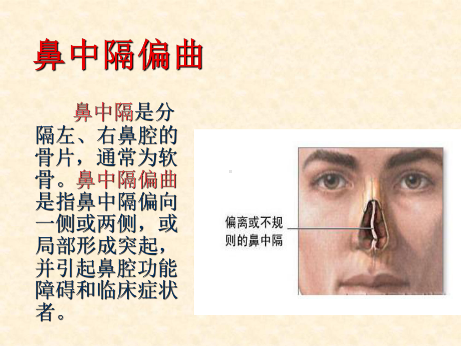 鼻中隔偏曲护理教学课件.ppt_第2页