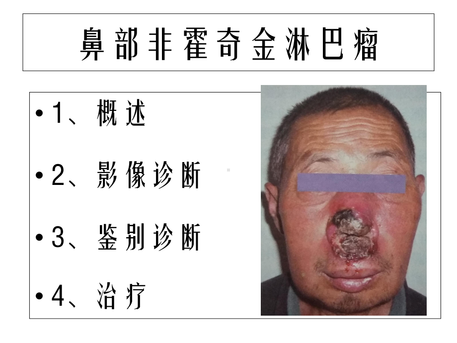 鼻部非霍奇金淋巴瘤PPT培训课件.ppt_第2页