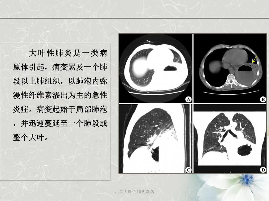 儿童大叶性肺炎新版培训课件.ppt_第3页