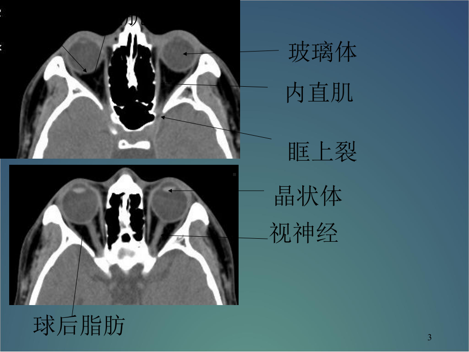 眼耳鼻喉CT解剖PPT幻灯片课件.ppt_第3页