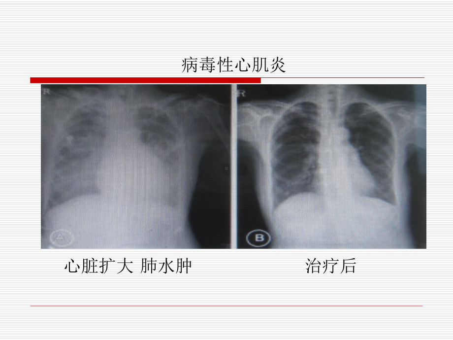 小儿暴发性心肌炎的诊断和治疗1课件.ppt_第3页