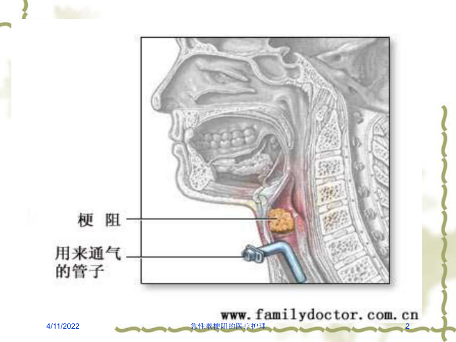 急性喉梗阻的医疗护理培训课件.ppt_第2页