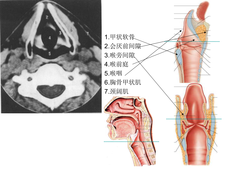 医学课件喉的CT解剖.ppt_第3页