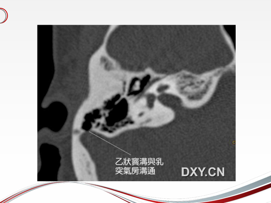 耳鸣与乙状窦憩室-ppt课件.ppt_第3页