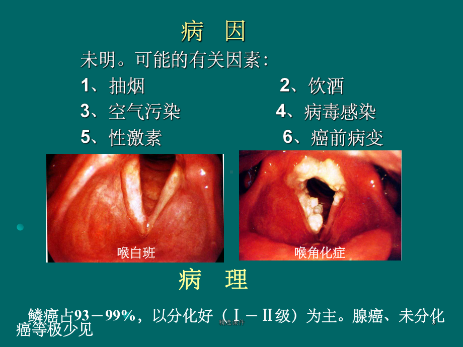 喉癌的护理ppt课件.ppt_第3页