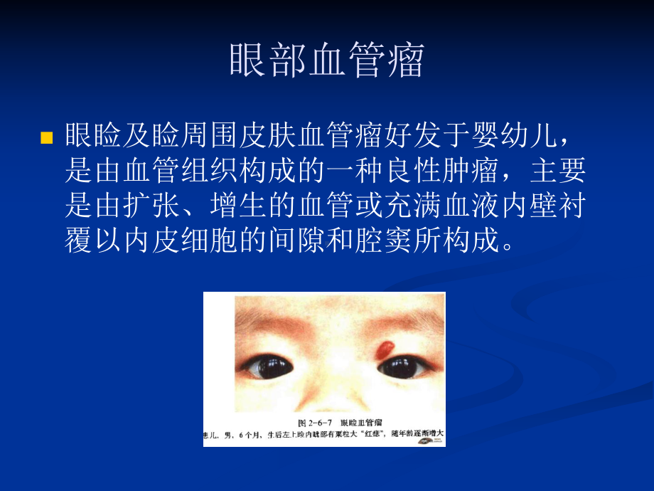 儿童常见眼部肿瘤1课件.ppt_第2页