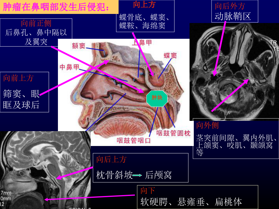 鼻咽癌的影像学诊断-课件.ppt_第3页