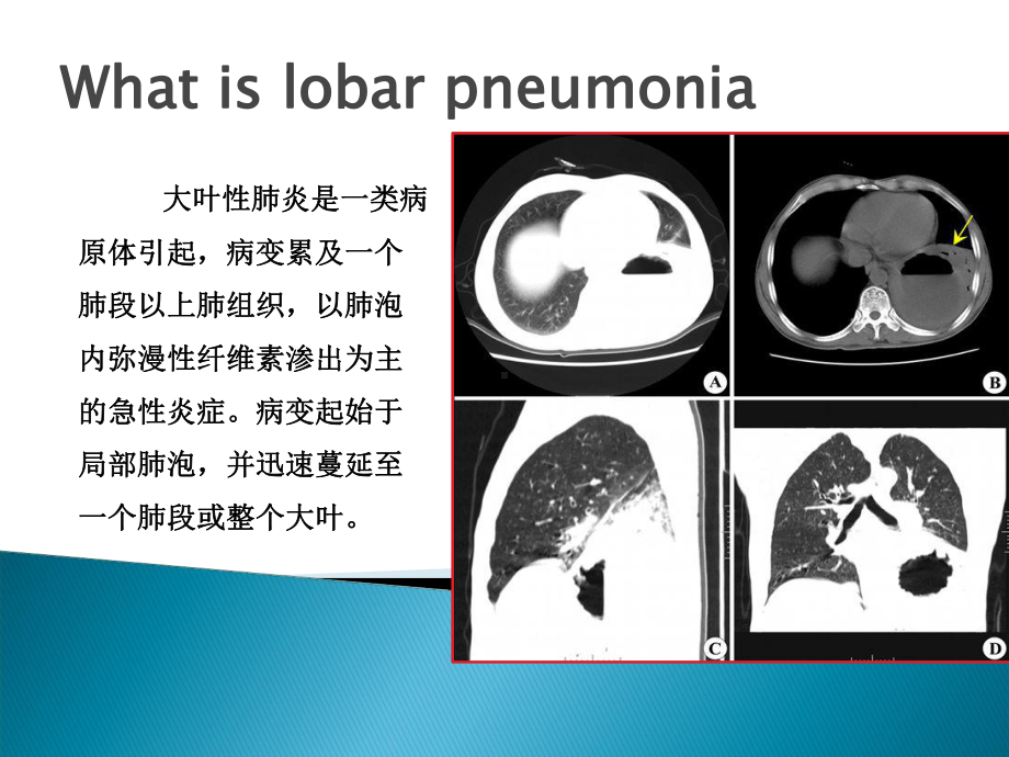 儿童大叶性肺炎PPT课件.ppt_第3页