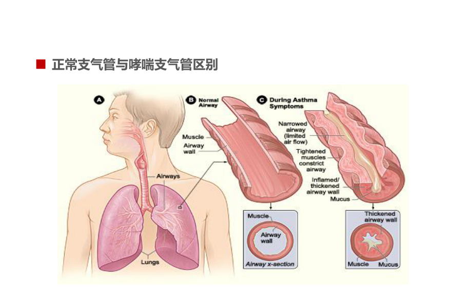 最新儿童哮喘防治主题讲座课件.ppt_第3页