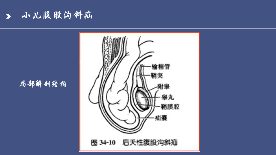 小儿腹股沟斜疝PPT课件.ppt_第3页