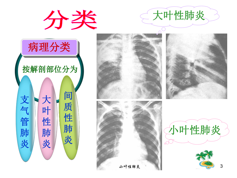 儿科护理小儿肺炎PPT课件.ppt_第3页