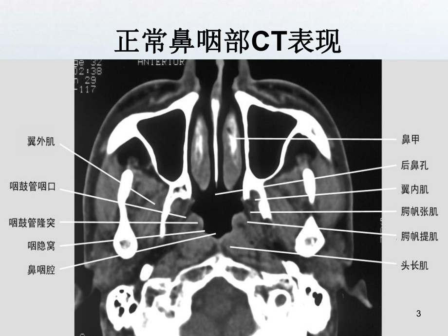 鼻咽纤维血管瘤PPT课件.ppt_第3页