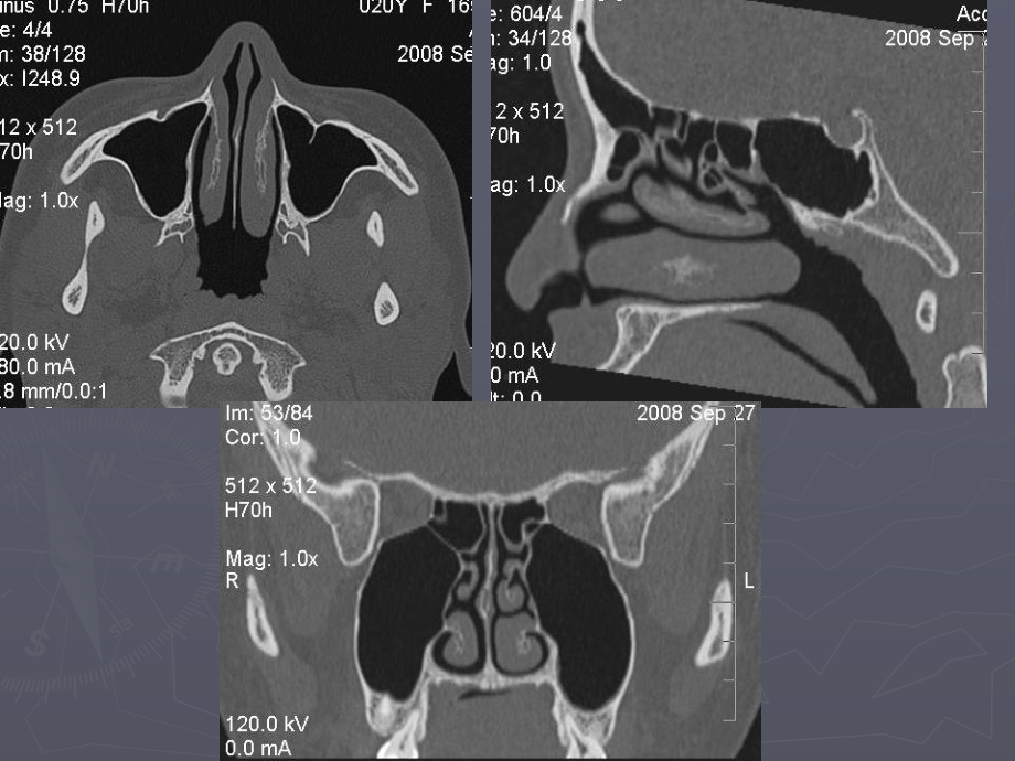 鼻腔副鼻窦常见病变的影像学诊断- PPT课件.ppt_第3页