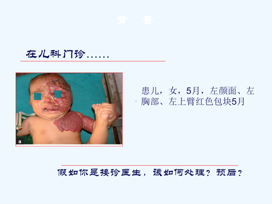 婴幼儿皮肤血管瘤的治疗进展课件.ppt_第2页