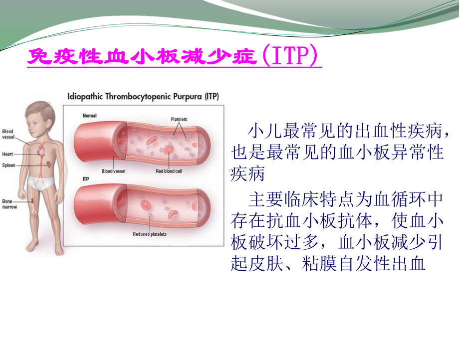 儿童免疫性血小板减少症的诊治课件.pptx_第2页