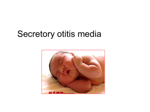 耳鼻咽喉科学英文版课件 secretory otitis media.ppt