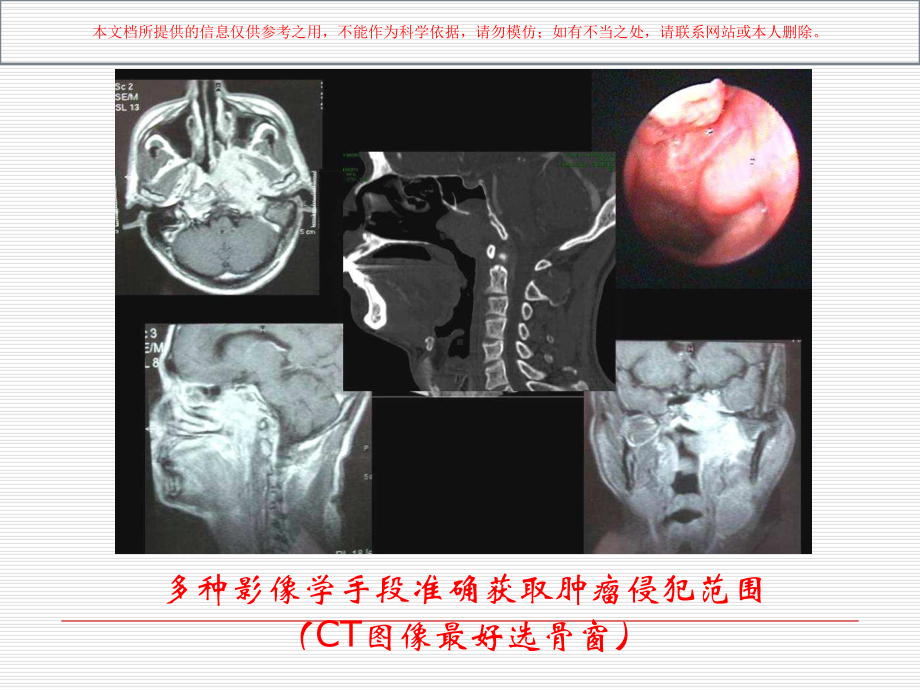 鼻咽癌调强放射治疗靶区勾画的基本方式建议培训课件.ppt_第3页