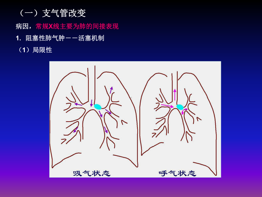 呼吸系统X线基本病变课件.ppt_第2页