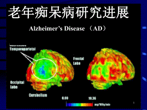 老年痴呆病研究进展PPT课件.ppt