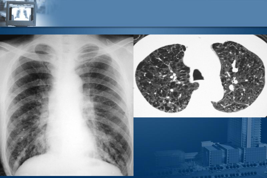 呼吸系统影像学课件.ppt_第3页