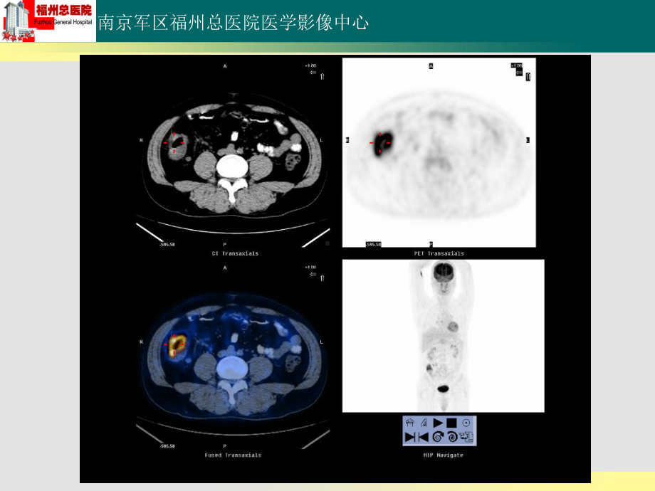 结肠炎性肉芽肿性病变PET-CT-影像FTP课件.ppt_第3页