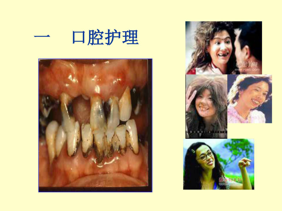 口腔护理与会阴护理课件.ppt_第2页