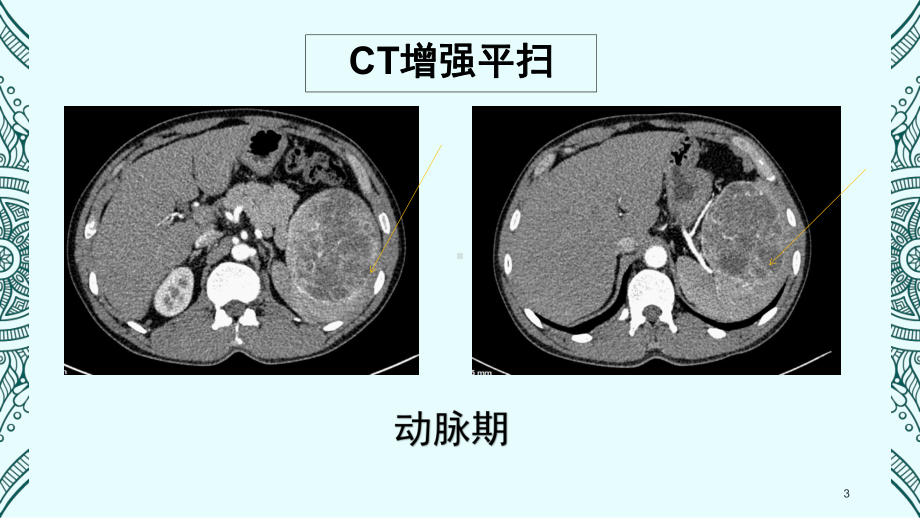 脾脏窦岸细胞血管瘤影像病例讨论PPT课件.ppt_第3页