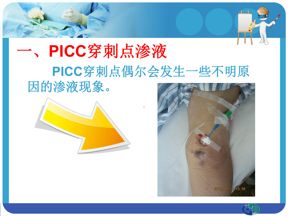 PICC穿刺点渗液与及皮肤过敏的处理课件.ppt_第2页