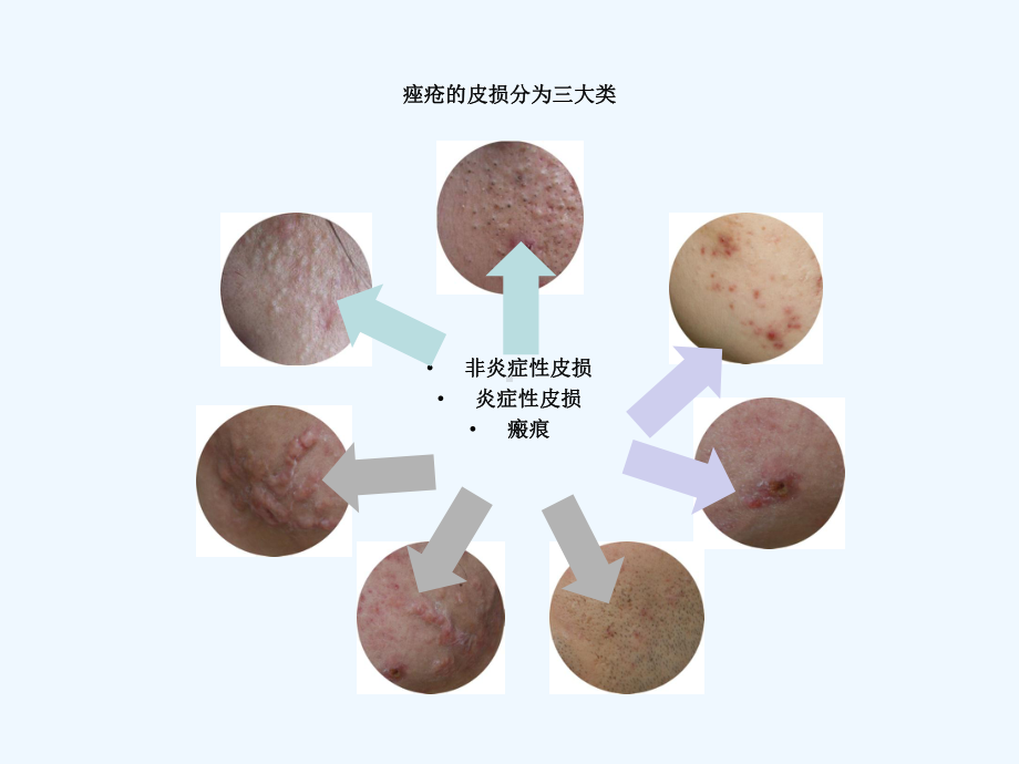 痤疮诊断与治疗-院内继教讲座课件.ppt_第3页