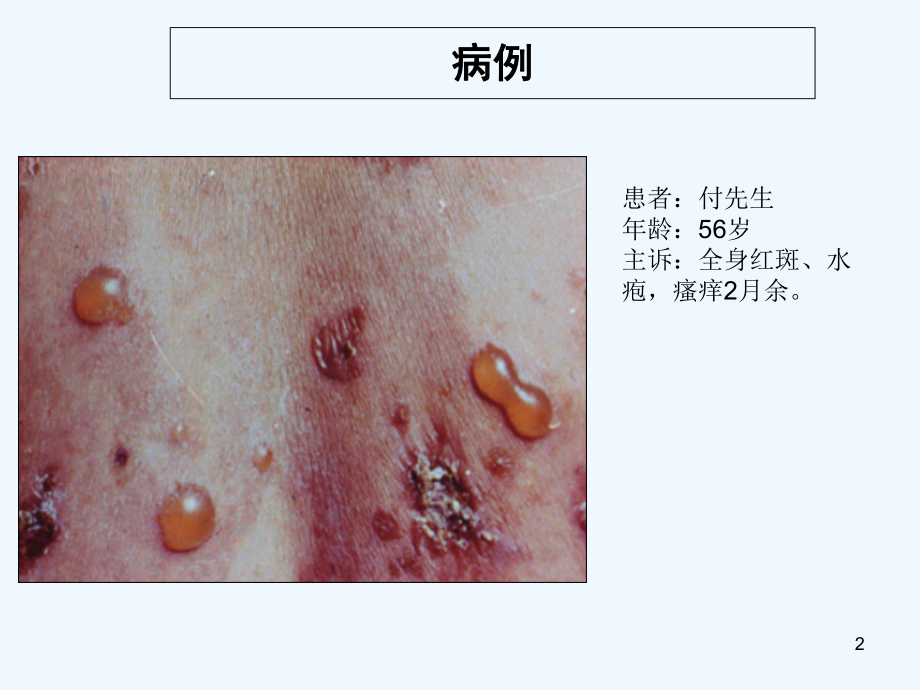 大疱性类天疱疮-PPT课件.ppt_第2页