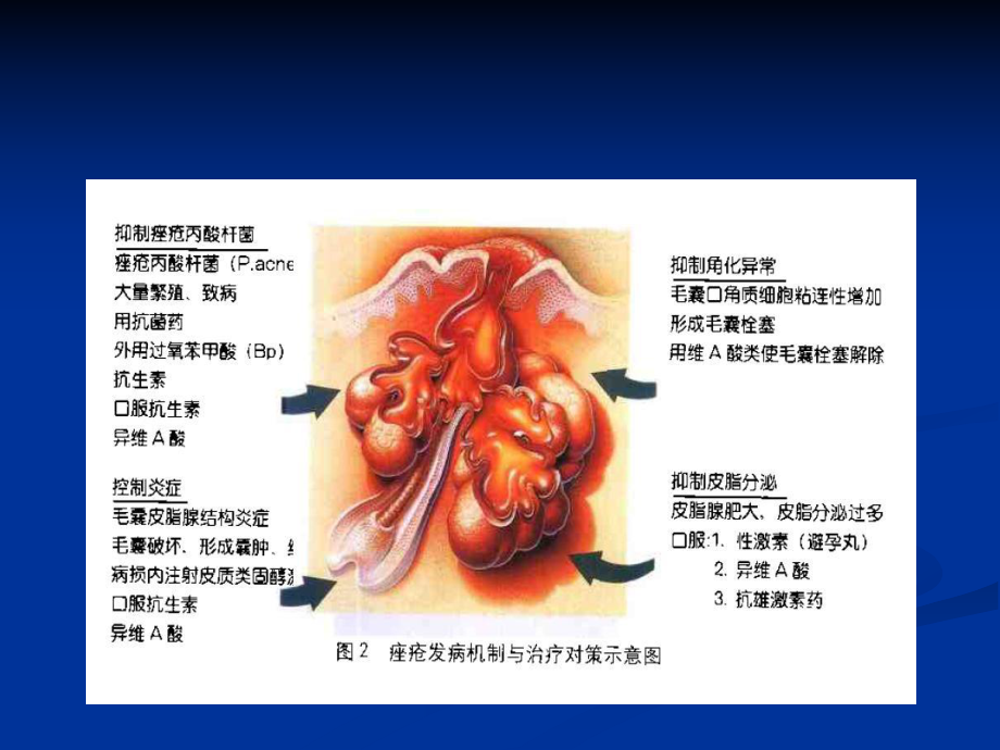 痤疮治疗方法-PPT课件.ppt_第2页