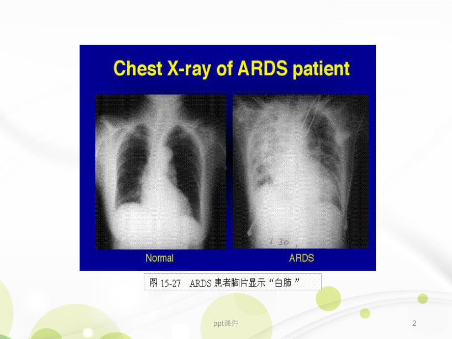 急性呼吸窘迫综合征ARDS护理查房-ppt课件.ppt_第2页