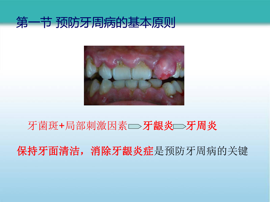 牙周病的预防和疗效维护课件.pptx_第2页