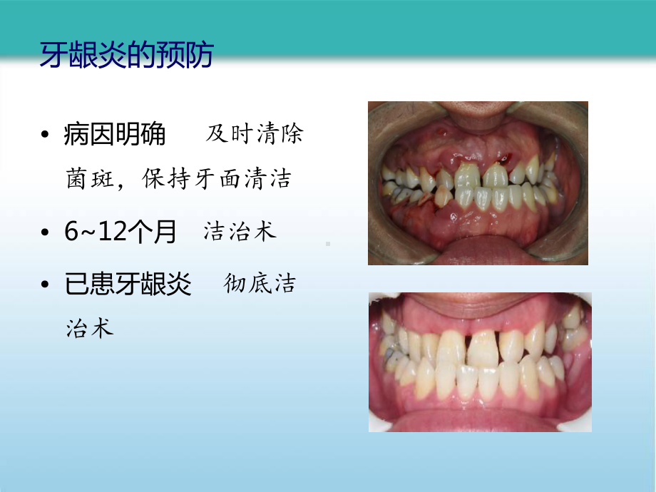 牙周病的预防和疗效维护课件.pptx_第3页