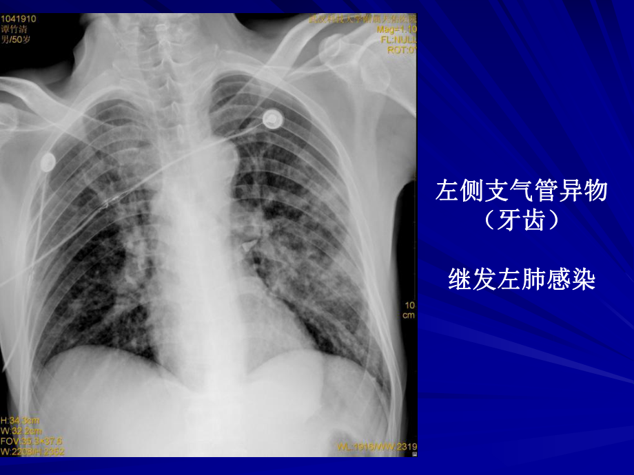 呼吸系统常见疾病影像诊断课件.ppt_第3页