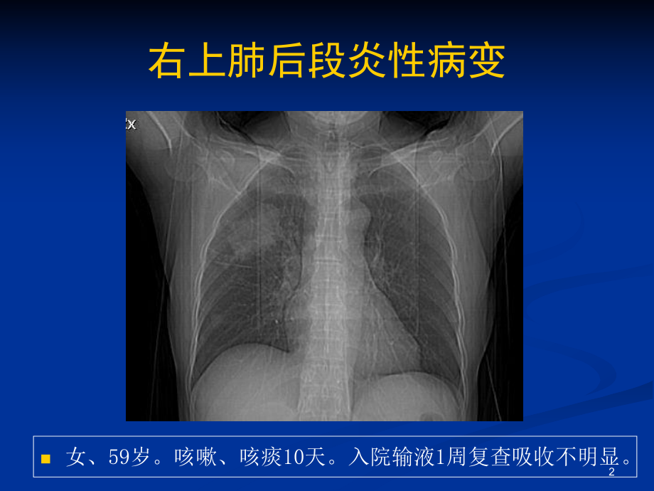 肺部感染性病变PPT课件.ppt_第2页