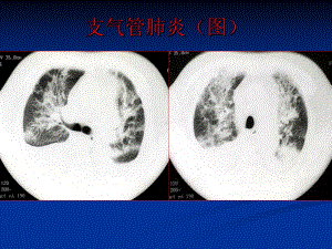 医学影像诊断学-呼吸系统4课件.ppt