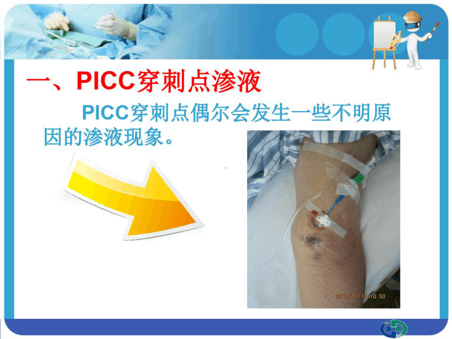 PICC穿刺点渗液及皮肤过敏处理课件.ppt_第2页