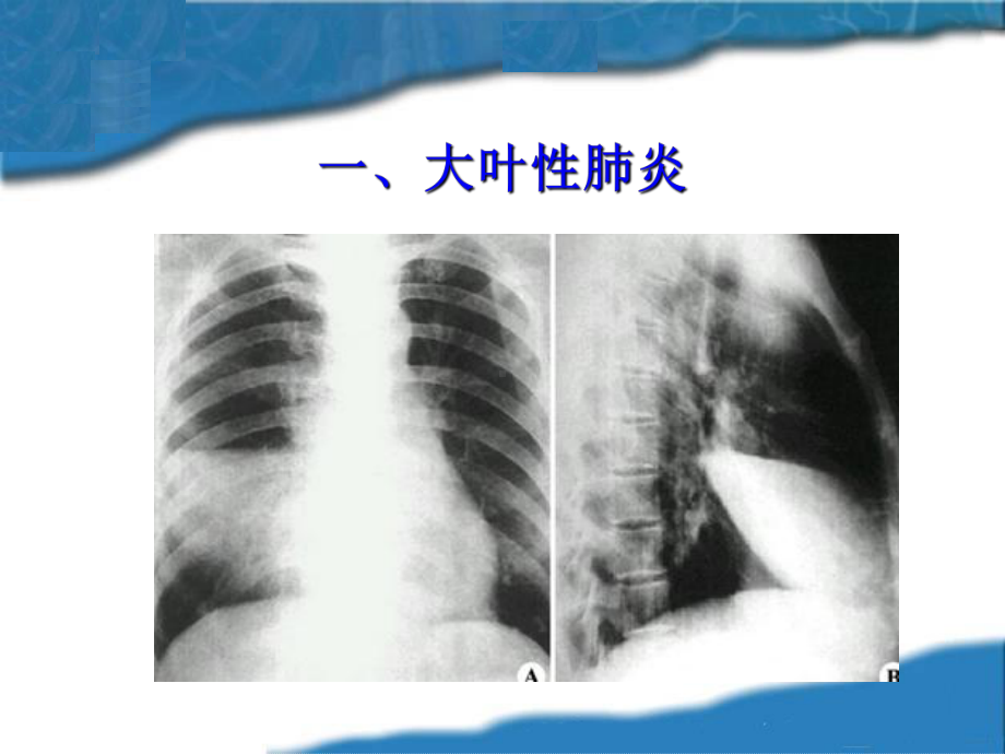 呼吸系统常见症状体征1-诊断学教研室-新-课件.ppt_第3页