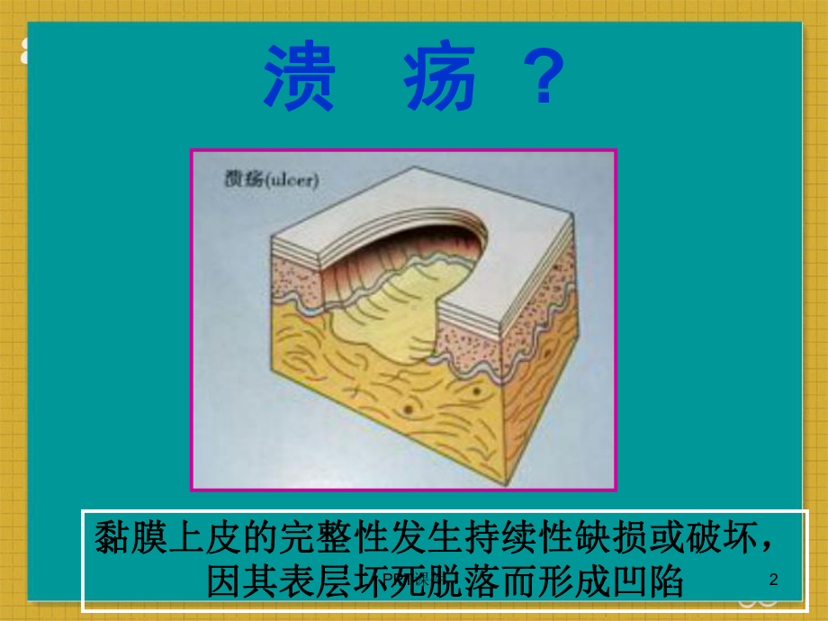 口腔黏膜溃疡类疾病-ppt课件.ppt_第2页