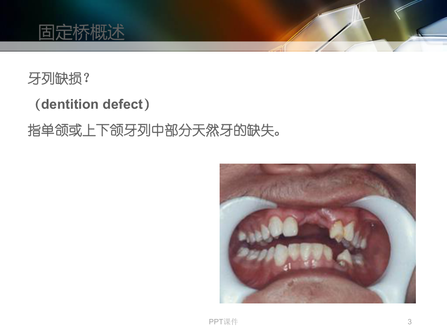 口腔修复学-固定桥-ppt课件.ppt_第3页