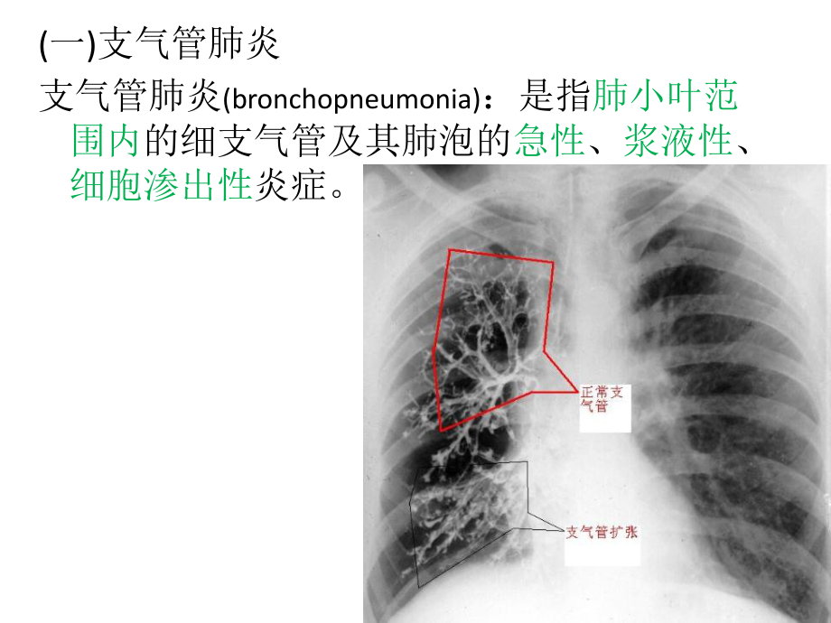 第十五章-呼吸系统病理1课件.pptx_第3页